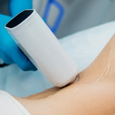 UNDERARM LASER HAIR REMOVAL